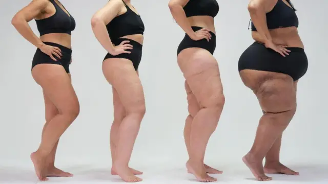 Progresión del lipedema